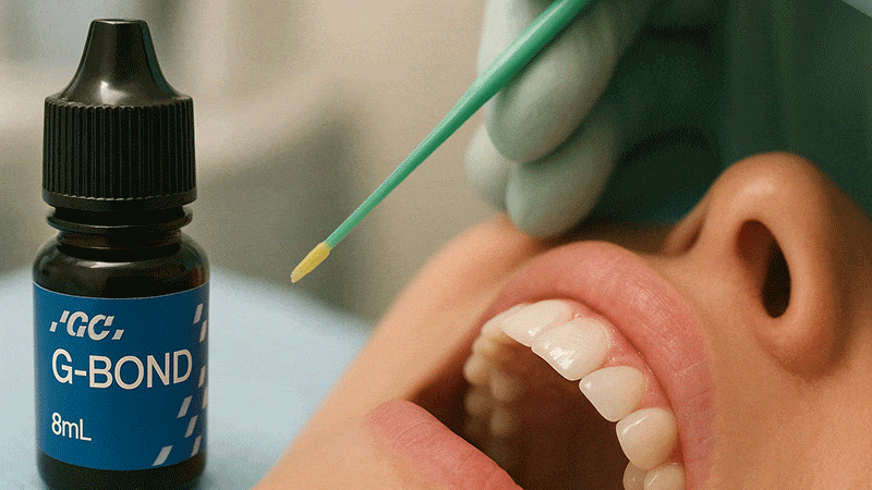 باندینگ جی سی