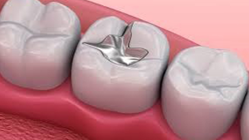 آمالگام دندانپزشکی