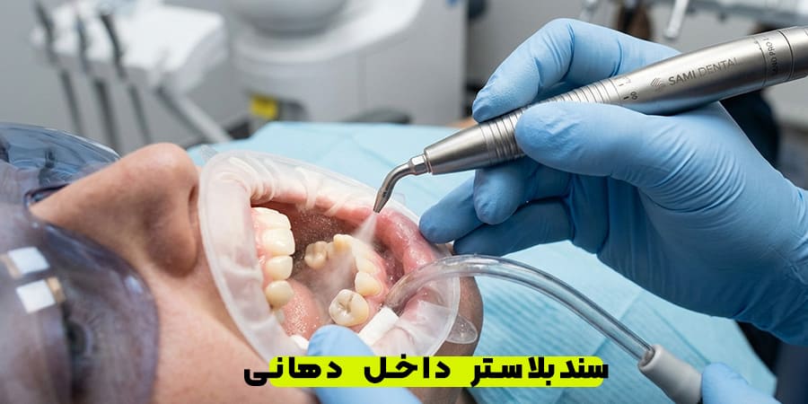 سند بلاستر داخل دهانی