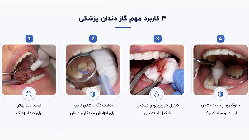 کاربرد گاز دندانپزشکی
