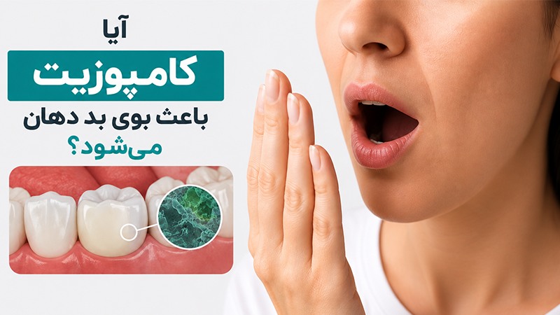 بوی بد دهان بعد از کامپوزیت