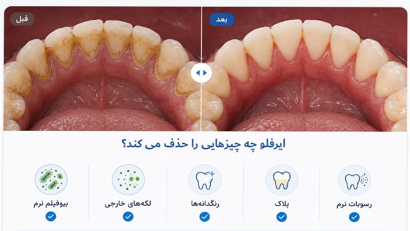 ایر فلو چه چیزهایی را از سطح دندان حذف می‌کند؟