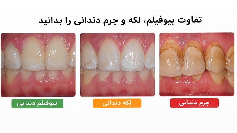 تفاوت بیوفیلم، لکه و جرم دندانی