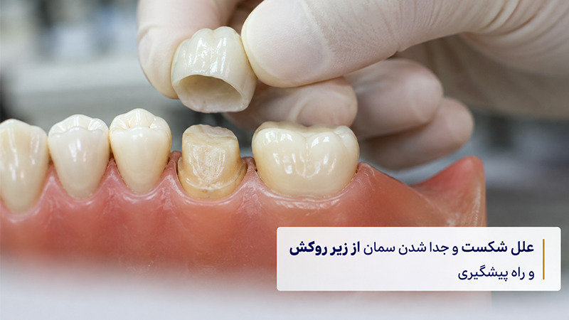 علت جدا شدن سمان زیر روکش