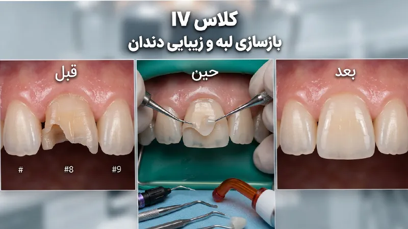 کامپوزیت مناسب کلاس IV