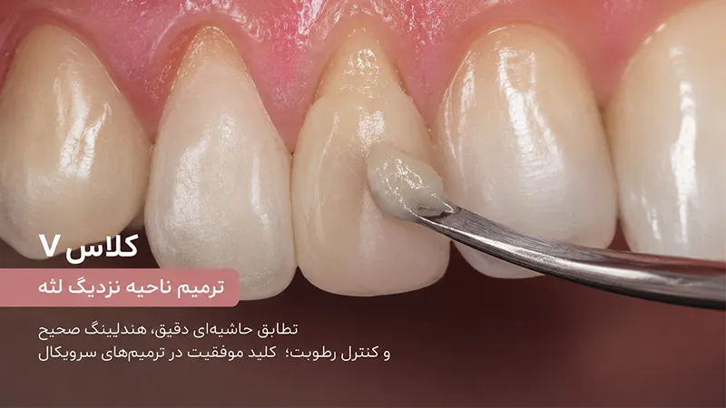 کامپوزیت مناسب کلاس V 
