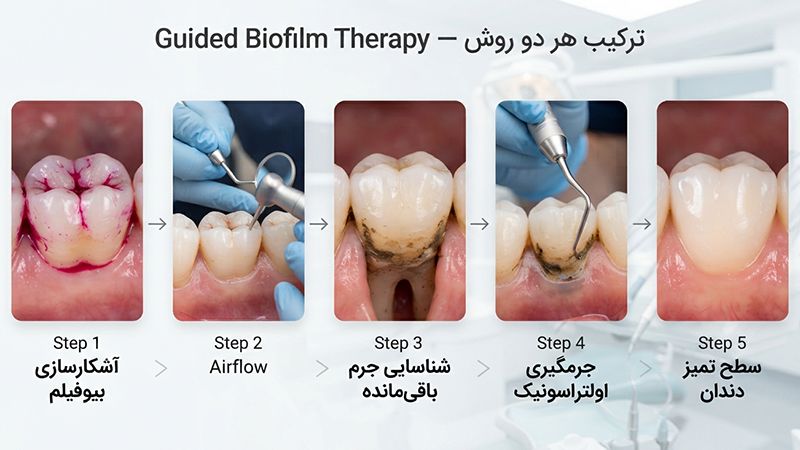 ترکیب ایرفلو و جرمگیری Guided Biofilm Therapy