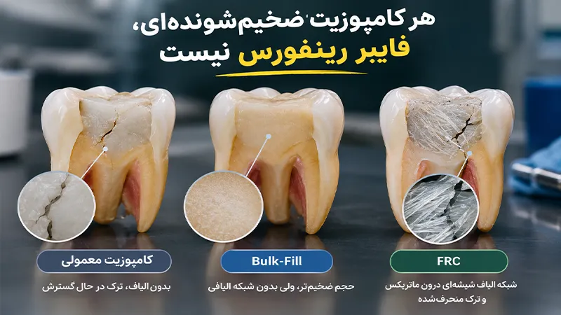 تفاوت FRC با کامپوزیت‌های معمولی و بالک‌فیل