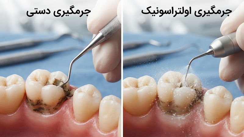 تفاوت جرم‌گیری دستی و اولتراسونیک
