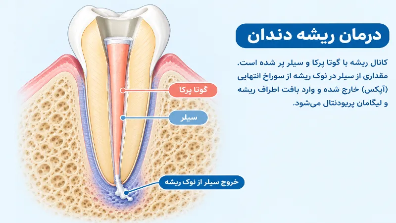 خروج سیلر از اپکس در درمان ریشه دندان