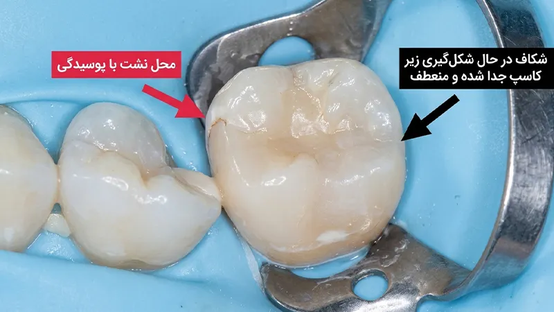کامپوزیت‌های معمولی در حفرات بزرگ