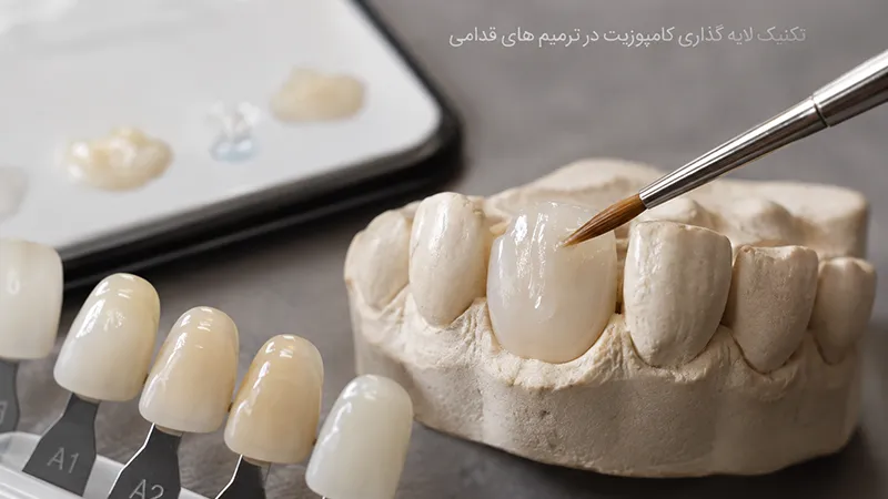لایه گذاری کامپوزیت در ترمیم های قدامی