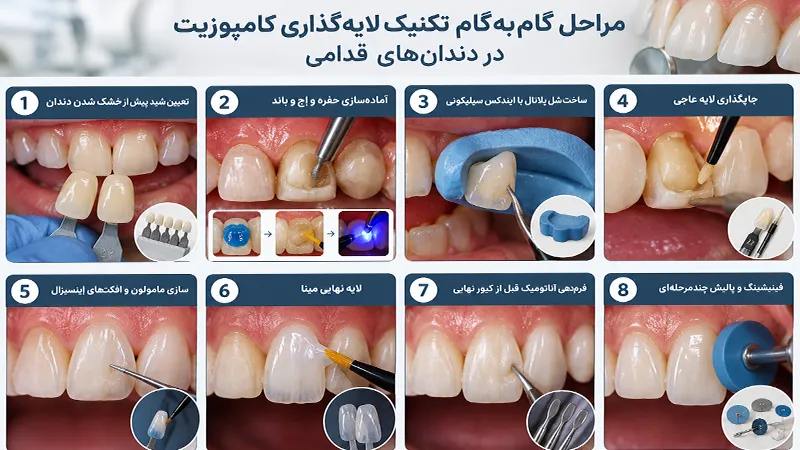 مراحل لایه‌گذاری کامپوزیت در دندان‌های قدامی