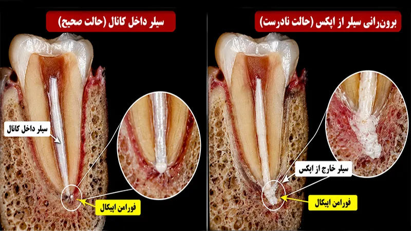 مقایسه سیلر داخل کانال و برون‌رانی از فورامن اپیکال در درمان ریشه