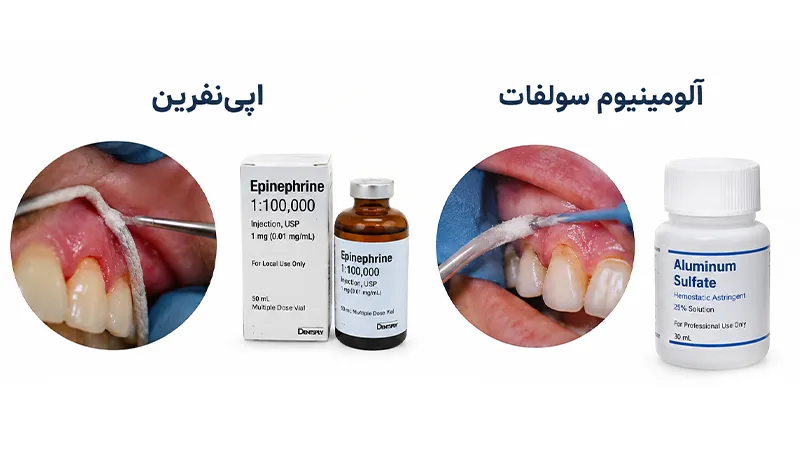 اپی‌نفرین یا آلومینیوم سولفات در ریتراکشن لثه