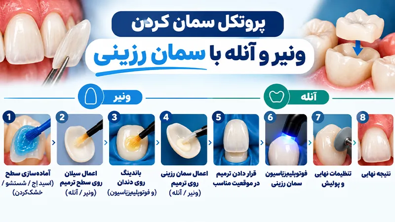 پروتکل سمان کردن ونیر و آنله با سمان رزینی-سامی دنتال